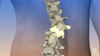 Straightening Scoliosis Mayo Clinic