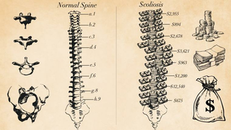 Her Spine Is So Curved She Can Barely Stand What Will Happen If