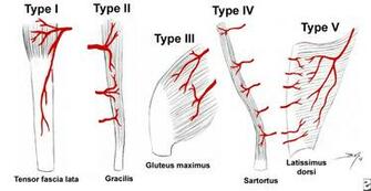 Sartorius Muscle Flap