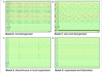 Eeg Background Scoring A Score Normal Organized Pattern B