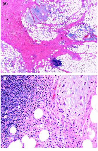 Histology Reveals Benign Adipocytic And Fibrous Components With A