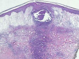 Sweet Syndrome Acute Neutrophilic Dermatosis Dermnet Nz Auto Design