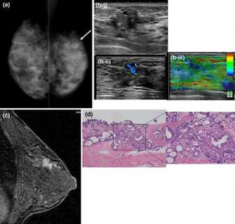 Case A Mmg Mlo Shows Nodular Density On U Area Of The