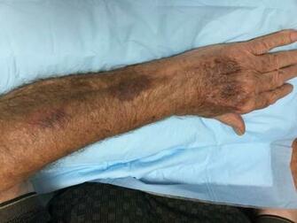 Senile Purpura All About Veins
