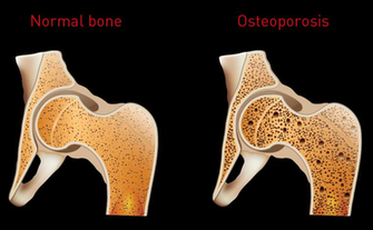 Osteoporosis Coffee And Health