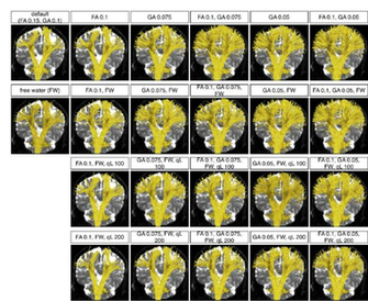 Two Tensor Ukf Tractography Reconstructions Of The Cst From