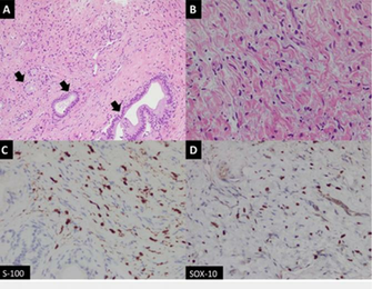 Histology Slides A Fascicles Of Spindle Shaped Cells With