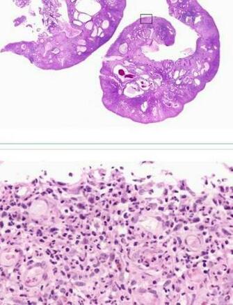 Sessile Polyp Juvenile Polyposis Studyblue Notes Note N