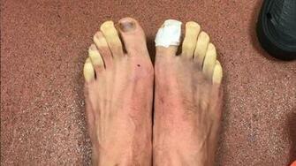 Liverpool Star Adam Lallana S Toes Turn Yellow After Match On