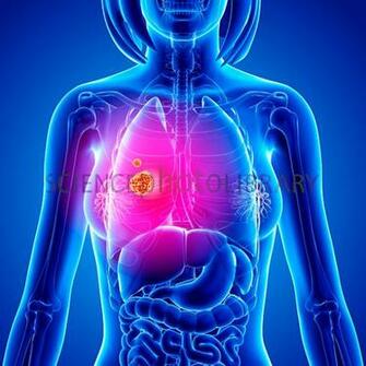 Lung Cancer Artwork Stock Image F008 Enlarged Science