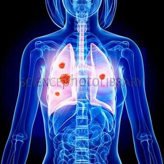 Lung Cancer Artwork Stock Image F008 Enlarged Science