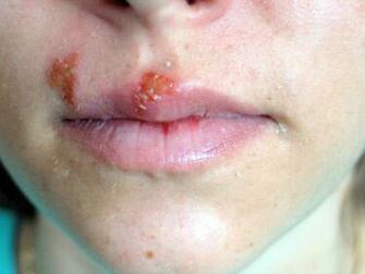 How Scared Should I Be Of The Rise In Stds Vice