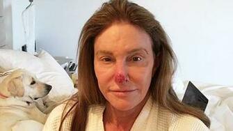 Caitlyn Jenner Shares Photo Showing Sun Damage Removed From Nose