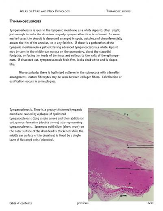 Table Of Contents Previous Next Tympanosclerosis Is Seen In The