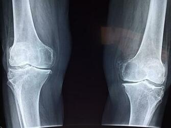 Fda Clears Zimmer Biomet S Robotic Knee Surgery System Fiercebiotech