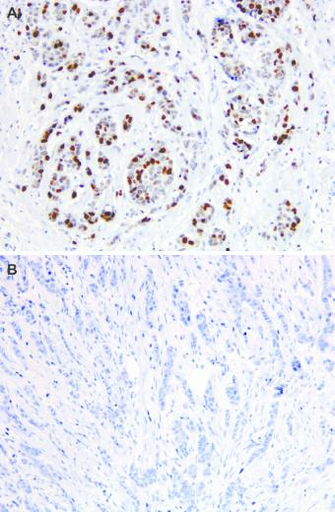 Immunostaining For Top2a In Preoperative Breast Cancer Core