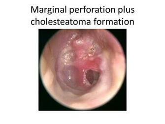 Dull Tympanic Membrane For
