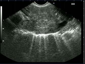 Lung Cancer Core Biopsy Eus Fna