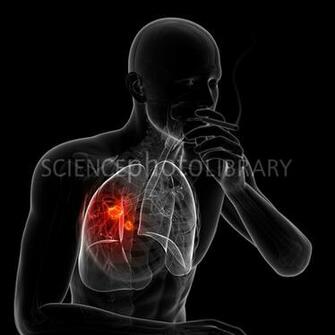 Lung Cancer Due To Smoking Artwork Stock Image F007 Enlarged