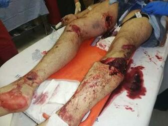 Watch Drag Racer Loses Leg After Horrific Crash The Citizen
