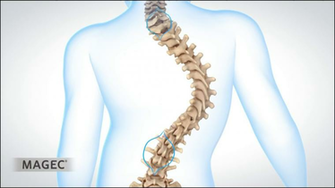 Magic Magnets To Treat Early Onset Scoliosis