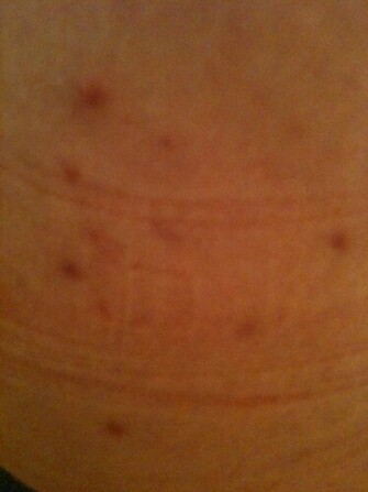 Butt Acne