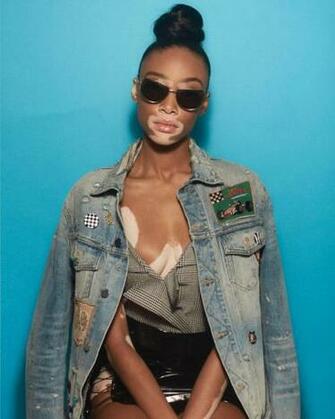 Winnie Harlow Bio Fitness Models Biography