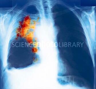 Wallpaper Lung Cancer Kills More People X Ray