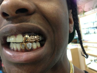 Gold Teeth