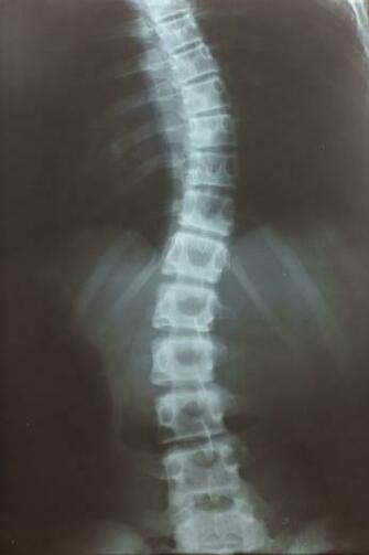 Best Scoliosis Wallpaper