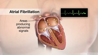 Atrial Flutter