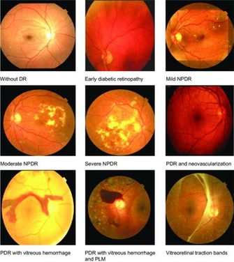 Fundus Image Of Normal Background Retinopathy Mild Npdr
