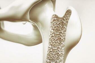 The Nuance In Treating Osteoporosis Research Updates And Approaches