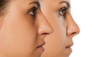 Why Good Ethnic Rhinoplasty Is So Hard To Find Quartz