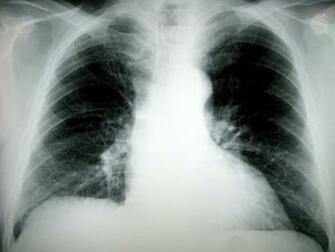 Funky Shunky Symptoms Of Lung Cancer In Women