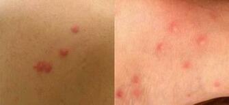 Closeups Of Bed Bug Bites Left And Flea Right On Human Skin