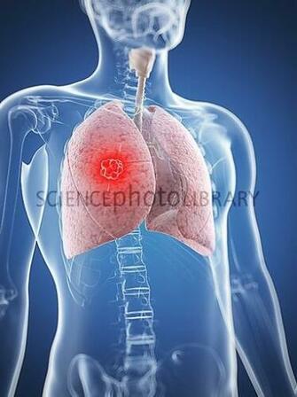 Lung Cancer Artwork Stock Image F006 Enlarged Science